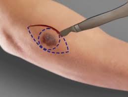 Skin Cancer Surgery